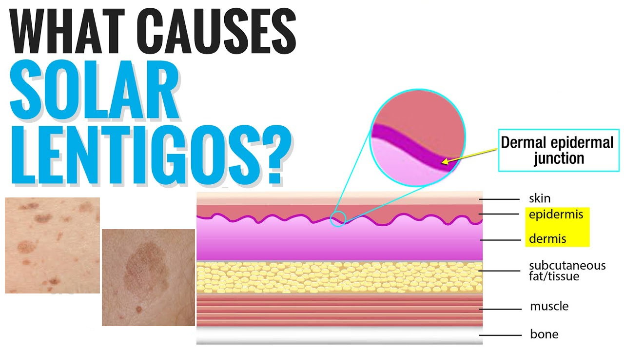 孚美达“氟轻松氢醌维A酸乳膏”能用于老年斑治疗吗？