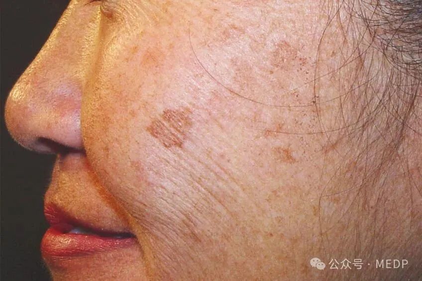 老年斑、晒斑、日光性雀斑是一回事吗？